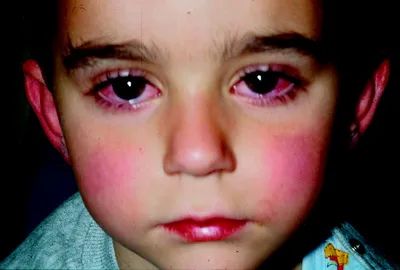 В Украине детей поразил синдром Кавасаки, связанный с COVID-19. Он приводит  к токсическому шоку
