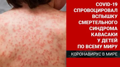 Чем опасен синдром Кавасаки: все симптомы и осложнения - 10.06.2020,  Sputnik Армения