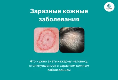 Псориаз | Клиника дерматологии и косметологии Aderm | Дзен