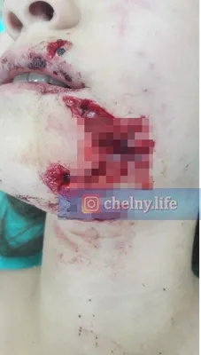 Прокуратура начала проверку после нападения бродячей собаки на школьницу в  Копейске