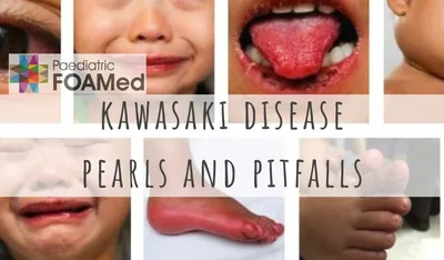 Kawasaki Disease | Johns Hopkins Medicine