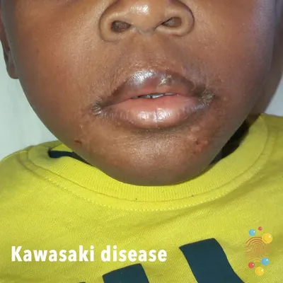 Kawasaki Disease Symptoms in Children