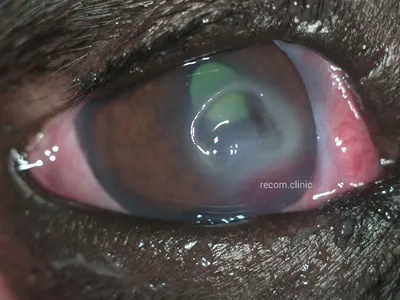 Травма глаза кошачьим когтем/Cat claw injury of the eye