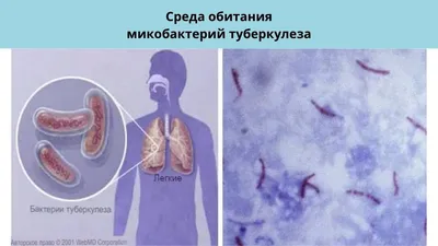 Туберкулез – история 7 000 лет - ГКБ имени В.П. Демихова