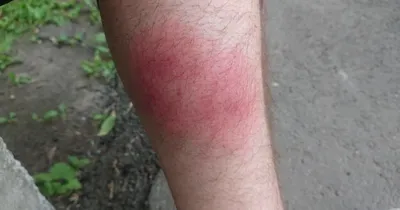Семейный отдых в Египте превратился в ад из-за укусов гигантских комаров:  шокирующие фото
