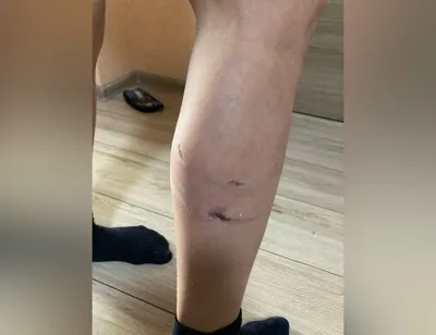 А ведь это могли быть дети!» В Краснодаре собака напала на женщину около  детской поликлиники и укусила её за ногу