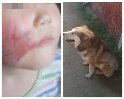 Полщеки в клочья\". В Якутске собака укусила 5-летнюю девочке за лицо