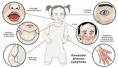 Kawasaki Disease | KidsHealth NZ