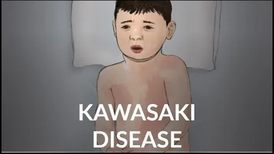Research trends on causes of Kawasaki disease in the COVID-19 era: focus on  viral infections