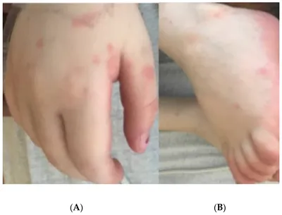 Coronavirus disease 2019-related Kawasaki syndrome: a case report | Journal  of Medical Case Reports | Full Text